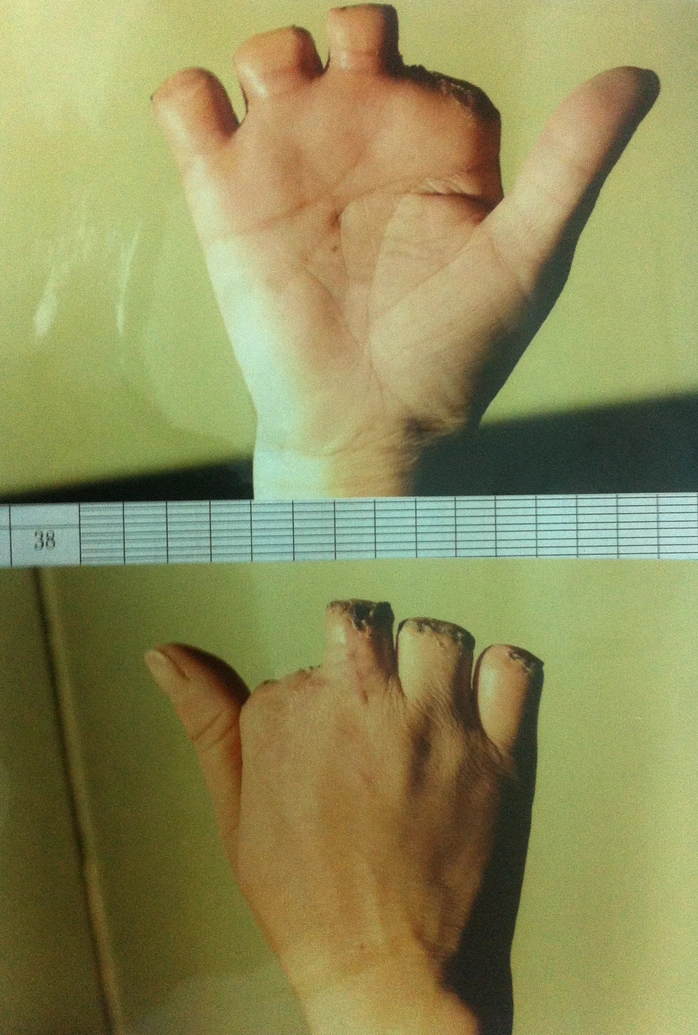 Bàn tay chị N. bị máy nghiến sạch 4 ngón