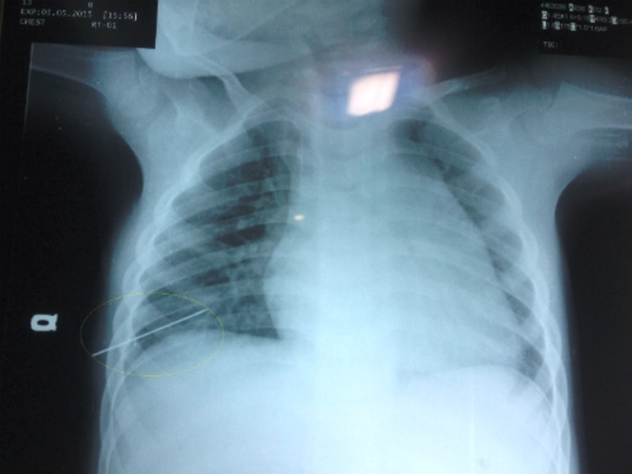 : Kết quả chụp X-quang phát hiện dị vật là chiếc kim dài 5cm đâm thủng phổi bé Cường 
Ảnh do BV Cu Ba cung cấp