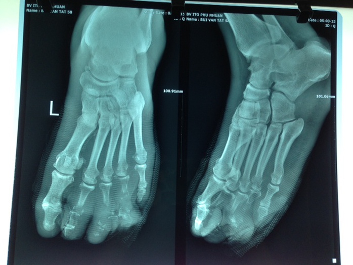 Bàn chân bệnh nhân đã hoại tử các ngón 2,3,4 do nhiễm trùng.