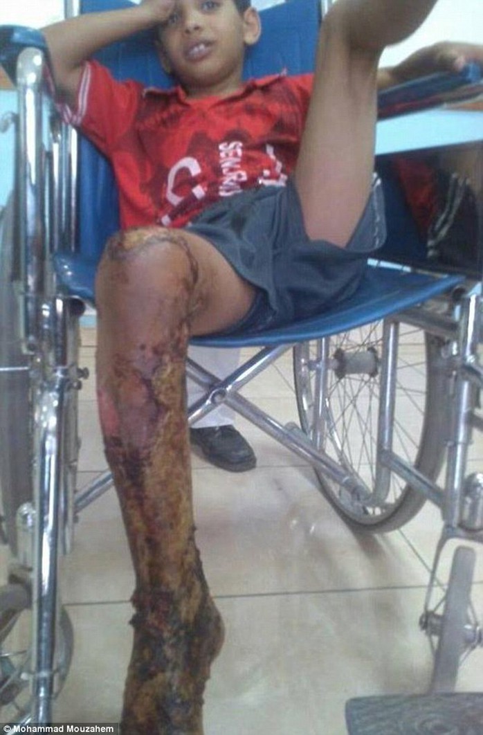 Bé trai bị phỏng nặng ở chân sau khi bị thiêu sống. Ảnh: Daily Mail