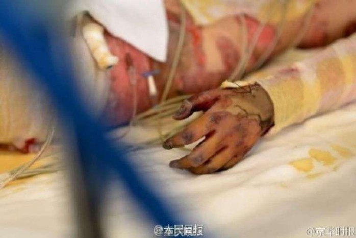 Guo Jiajia nằm tại bệnh viện. Ảnh: WEIBO