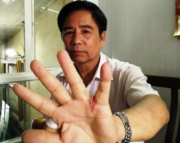 
Ông Nguyễn Văn Định với vết thương ở tay khi xông vào vật nhau với tên trộm táo tợn đế cứu vợ con
