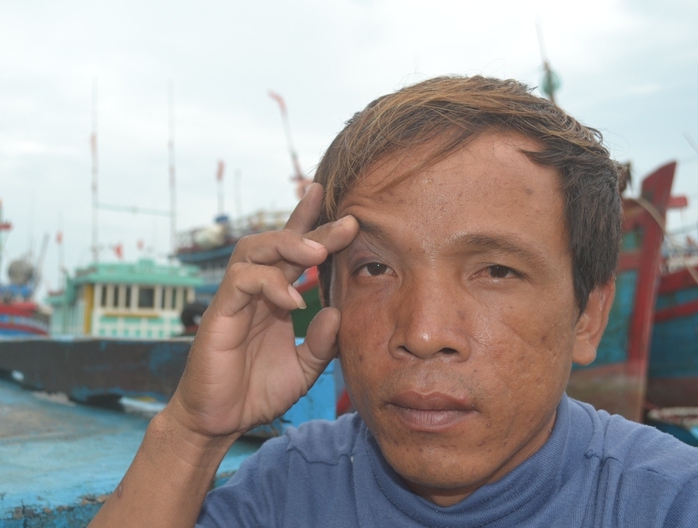 Một ngư dân bị phía Trung Quốc đánh bầm mắt