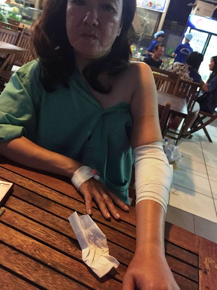 
Chị Nguyễn Thị Thu Thủy bị đánh gãy củi chỏ tay trái đang điều trị tại bệnh viện (ảnh người dân cung cấp)
