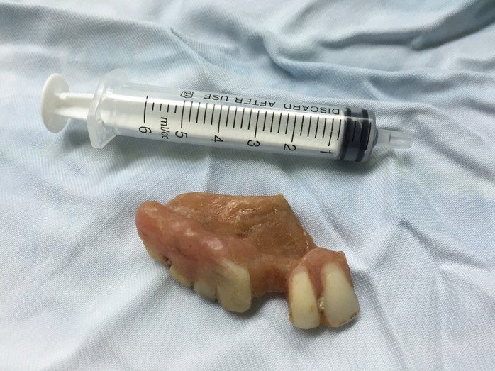 Hàm răng giả lấy ra từ thực quản bệnh nhân Ng.