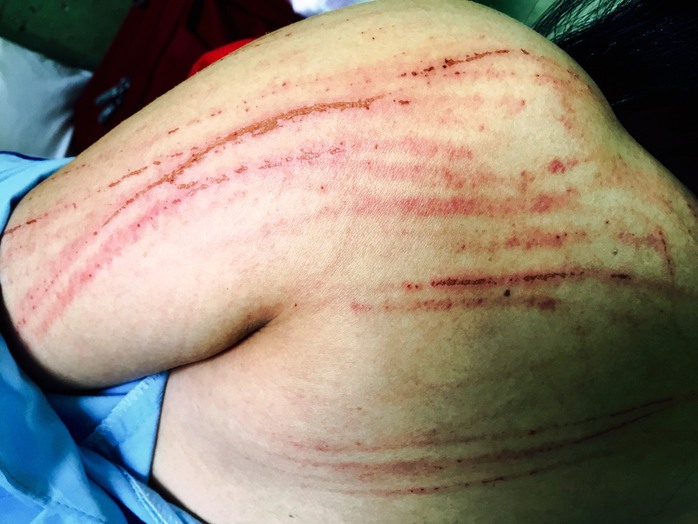 
Vết thương trên người của luật sư Võ Thị Tiết khi mới bị hành hung - Ảnh NVCC
