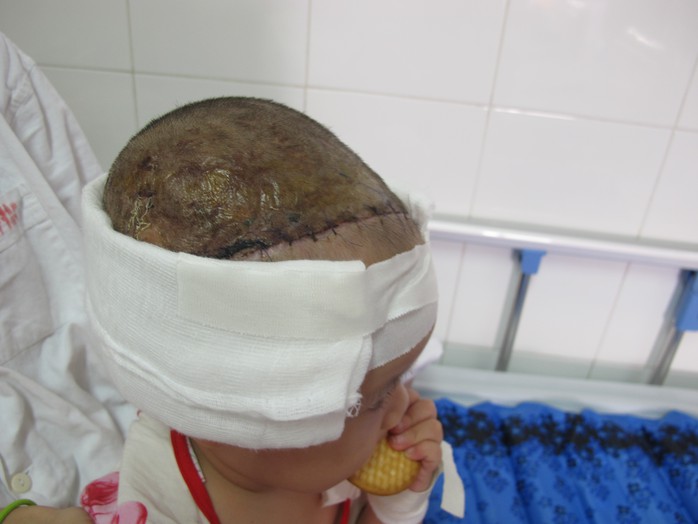 
Mảng da đầu của bé gái 2 tuổi sống và mọc tóc trở lại sau 2 tuần ghép nối
