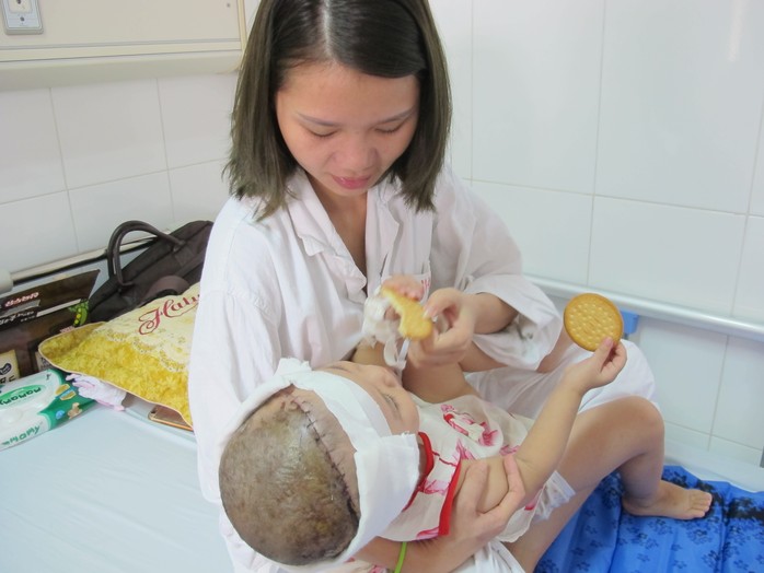 
Bé gái 2 tuổi bị lột gần như toàn bộ da đầu sau tai nạn

