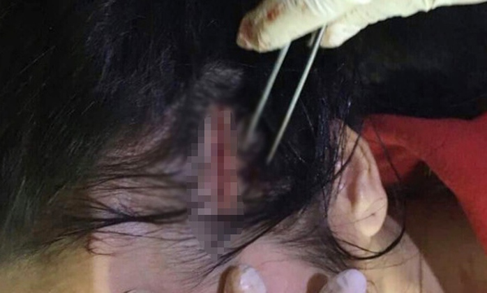 
Vết thương trên đầu của chị N. khi vào bệnh viện cấp cứu - Ảnh: Dân Việt
