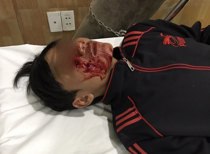 
Một trong 4 người thuộc lực lượng chức năng của phường Tân Hiệp bị đá ném trọng thương vùng mặt
