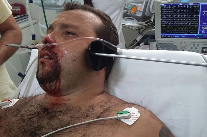 
Anh Hugo Pereira da Silva, 27 tuổi, bị lao móc xuyên thủng mặt. Ảnh: Lực lượng cứu hỏa bang Minas Gerais
