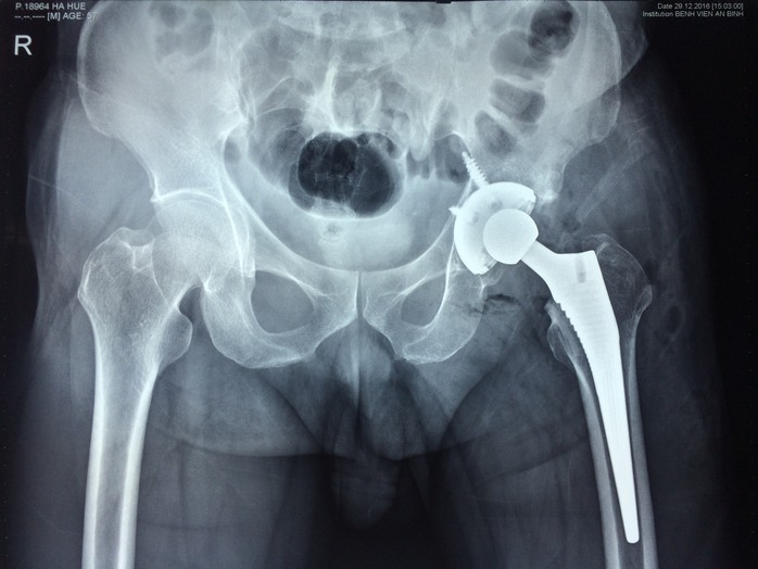 
Phim X-quang sau phẫu thuật: Phần khớp hư hỏng đã được thay thế bằng khớp háng nhân tạo, giúp bệnh nhân cử động lại được đồng thời cân chỉnh lại độ dài chân cho bằng với bên chân lành.
