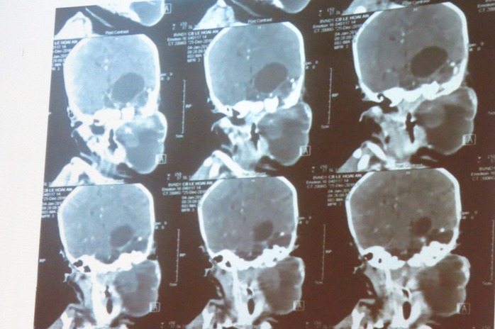 Hình ảnh khối bướu trên phim MRI