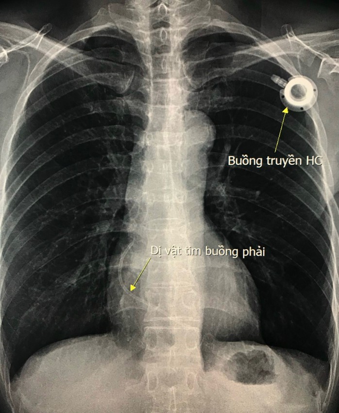 Gắp dị vật mắc kẹt ở tim nữ bệnh nhân - Ảnh 1.
