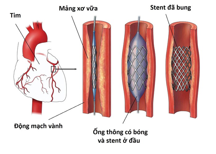 Yêu cầu báo cáo việc bệnh nhân đặt stent động mạch vành từ năm 2015 đến nay - Ảnh 1.