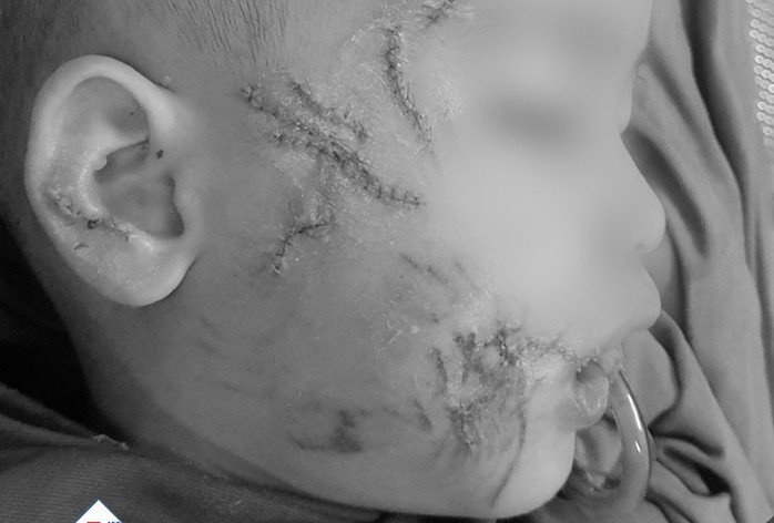 Bé trai 3 tuổi bị chó cắn tổn thương nghiêm trọng mặt và đầu - Ảnh 1.