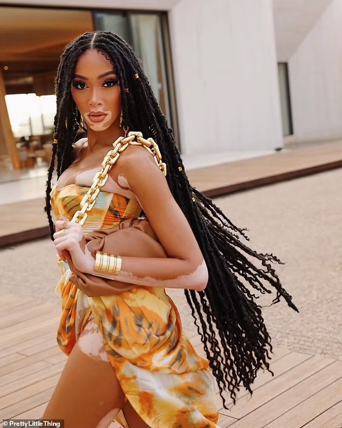 Siêu mẫu Winnie Harlow khoe đường cong “đốt cháy” ngày hè - Ảnh 3.