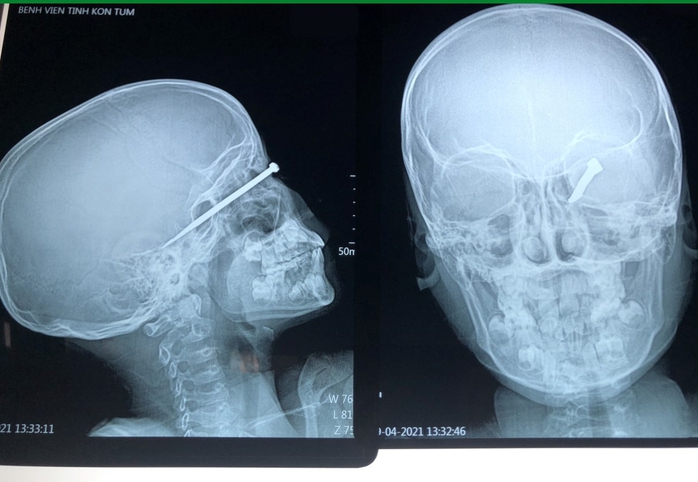 Bé trai 8 tuổi bị mũi tên bắn xuyên mắt, găm sâu vào sọ não - Ảnh 1.