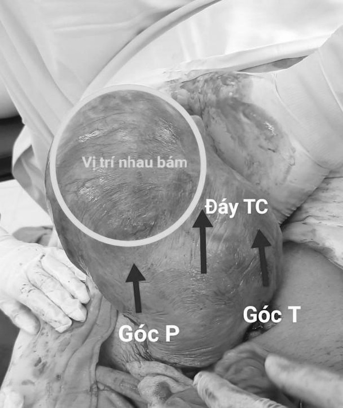 Cứu sống sản phụ mang thai ở góc tử cung hiếm gặp - Ảnh 1.