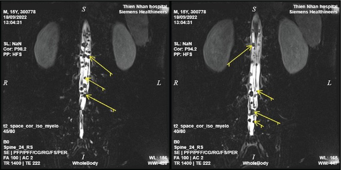 Chụp MRI toàn thân, phát hiện kịp thời ung thư di căn - Ảnh 3. Chụp MRI toàn thân, phát hiện kịp thời ung thư di căn - Ảnh 3.