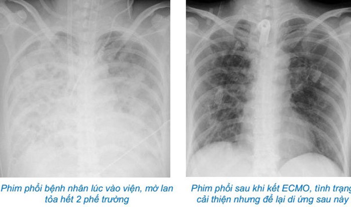 Lạm dụng corticoid tự điều trị cúm, nữ bệnh nhân 37 tuổi suy đa tạng - Ảnh 1.