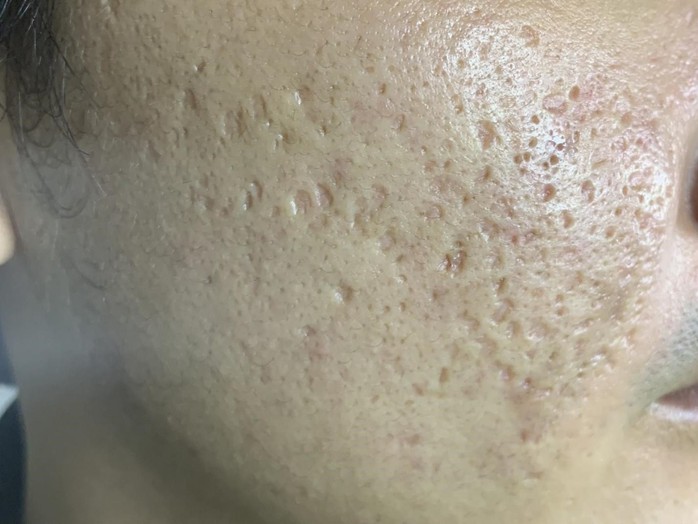 Vì sao chỉ nên điều trị sẹo rỗ với bác sĩ da liễu? - Ảnh 1. Vì sao chỉ nên điều trị sẹo rỗ với bác sĩ da liễu? - Ảnh 1.