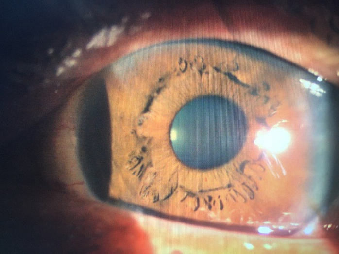 Người đàn ông ở Sóc Trăng mắc bệnh hiếm gặp ở 2 mắt - Ảnh 2.