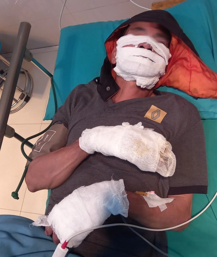 Điện thoại sạc qua đêm phát nổ khiến hai người bỏng nặng- Ảnh 1. Điện thoại sạc qua đêm phát nổ khiến hai người bỏng nặng- Ảnh 1.
