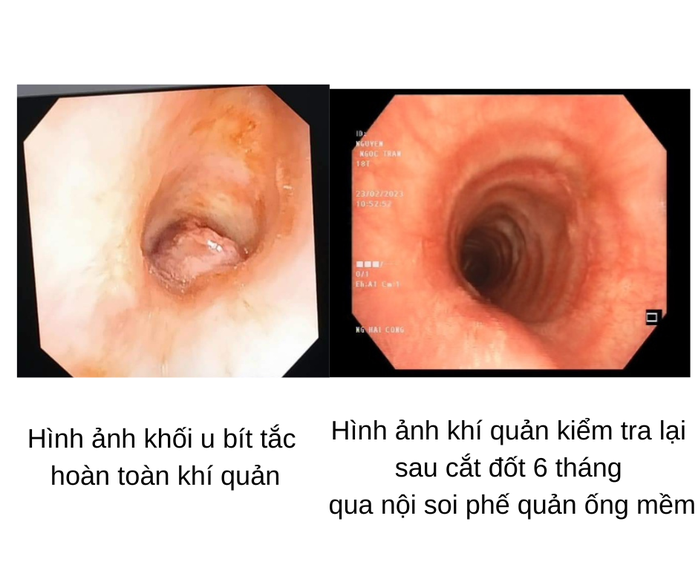 Bệnh hay gặp ở màng nhầy đường sinh dục nhưng lại xuất hiện ở khí quản cô gái 17 tuổi - Ảnh 2.