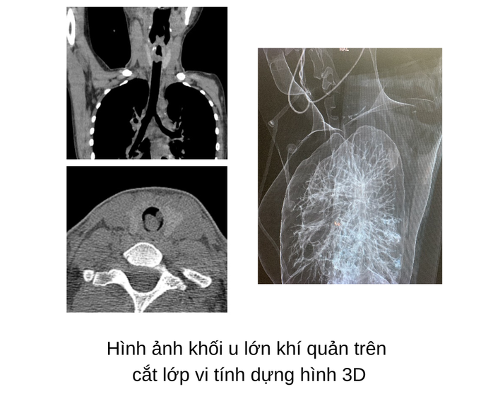 Bệnh hay gặp ở màng nhầy đường sinh dục nhưng lại xuất hiện ở khí quản cô gái 17 tuổi - Ảnh 1.