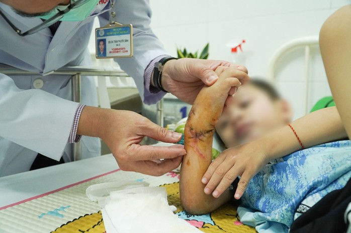Bệnh viện Chợ Rẫy kích hoạt báo động đỏ nối bàn tay đứt lìa của bé trai 5 tuổi - Ảnh 1.