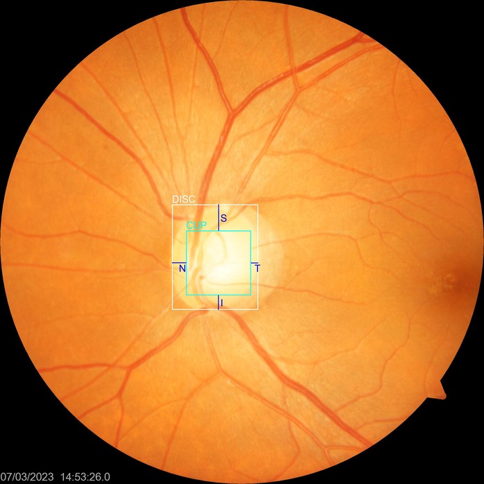 Ứng dụng AI hỗ trợ tầm soát bệnh cườm mắt - Ảnh 2.