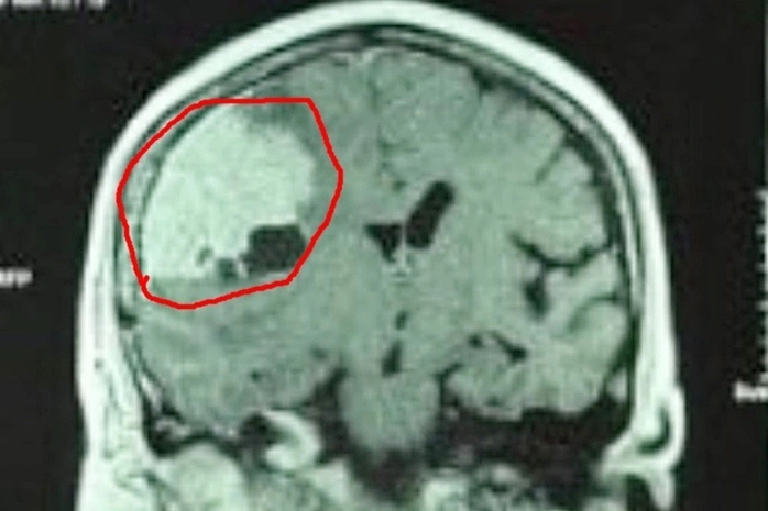 Đau đầu nhiều năm, đi khám mới phát hiện khối u màng não - Ảnh 1.