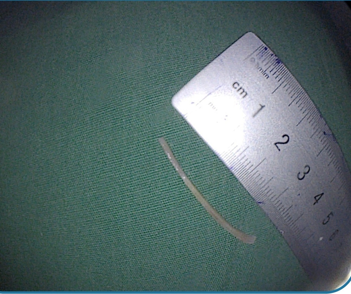 Đau bụng đi cấp cứu, phát hiện xương cá 3,5cm đâm thủng ruột - Ảnh 2.