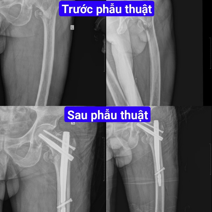 Cứu cụ ông gãy xương đùi thoát liệt - Ảnh 3.