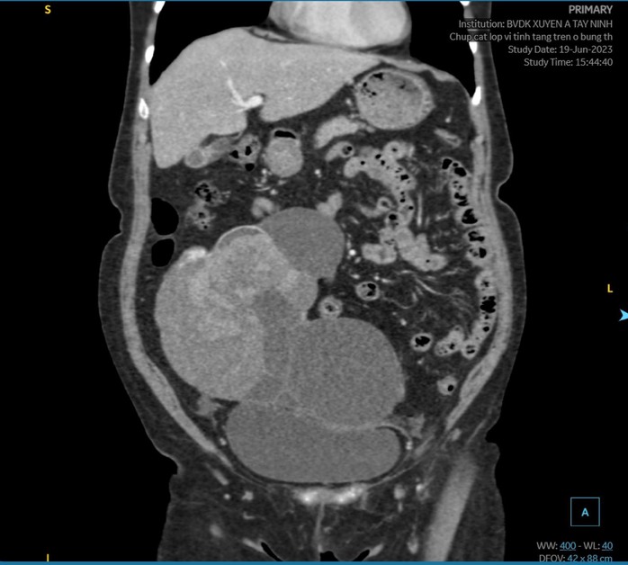 Phát hiện khối u 15cm khi đi khám đau bụng - Ảnh 2.
