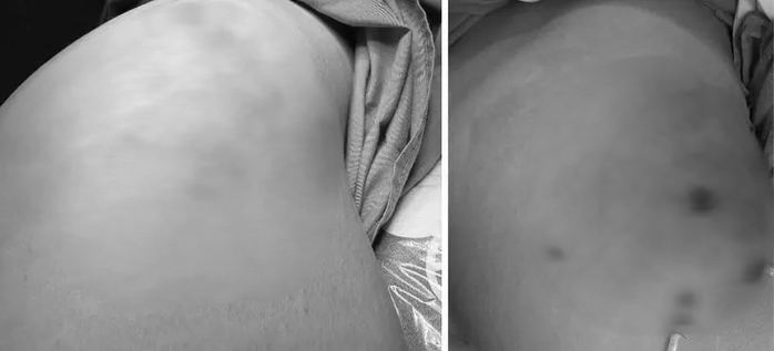 "Vòng 3" biến thành ổ mủ sau nhiều năm tiêm filler - Ảnh 1. "Vòng 3" biến thành ổ mủ sau nhiều năm tiêm filler - Ảnh 1.