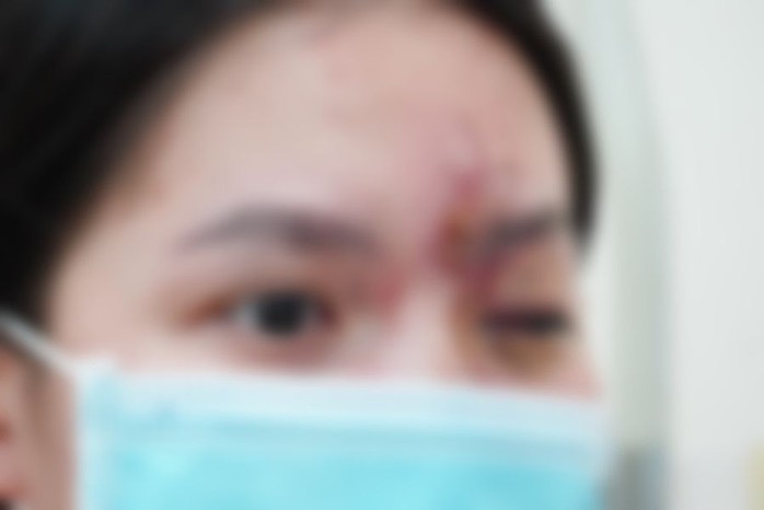 Cô gái trẻ mù mắt sau tiêm chất làm đẹp- Ảnh 1. Cô gái trẻ mù mắt sau tiêm chất làm đẹp- Ảnh 1.