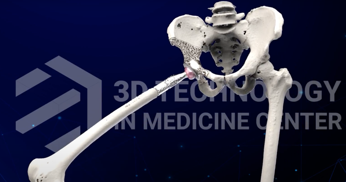 Bác sĩ tự thiết kế xương nhân tạo cứu bệnh nhân ung thư xương- Ảnh 2. Bác sĩ tự thiết kế xương nhân tạo cứu bệnh nhân ung thư xương- Ảnh 2.