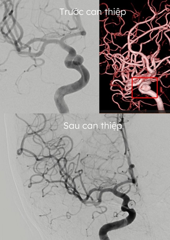 Tiết kiệm cả trăm triệu đồng cho ca bệnh suýt đột quỵ- Ảnh 1.