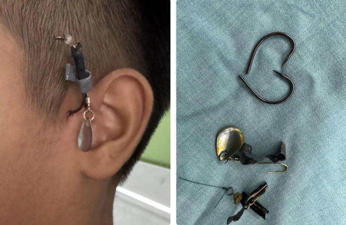 Đang xem câu cá, bé trai bị câu móc vào dây thần kinh quan trọng- Ảnh 1. Đang xem câu cá, bé trai bị câu móc vào dây thần kinh quan trọng- Ảnh 1.