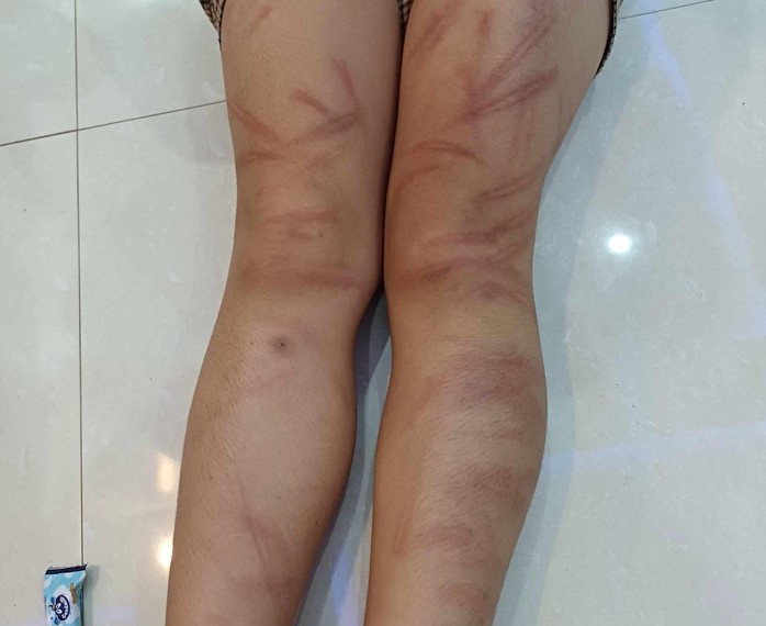 Vụ nhiều học sinh mầm non bị đánh bầm tím: Đánh các bạn là bé gái 5 tuổi - Ảnh 3. Vụ nhiều học sinh mầm non bị đánh bầm tím: Đánh các bạn là bé gái 5 tuổi - Ảnh 3.