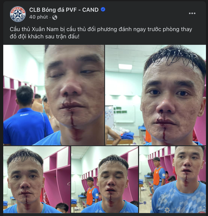 Xuân Nam bị đánh rách môi, hai đội PVF - CAND và Trẻ TP HCM tố nhau- Ảnh 1. Xuân Nam bị đánh rách môi, hai đội PVF - CAND và Trẻ TP HCM tố nhau- Ảnh 1.