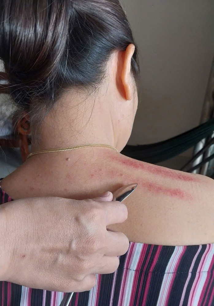 Nhiều người cạo gió bằng cách dùng các vật dụng có cạnh nhẵn như thìa, đồng xu, hoặc rìa bát... Ảnh: HẢI YẾN Nhiều người cạo gió bằng cách dùng các vật dụng có cạnh nhẵn như thìa, đồng xu, hoặc rìa bát... Ảnh: HẢI YẾN