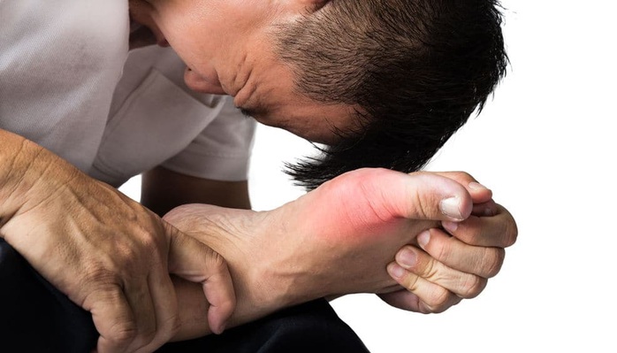 Tiết lộ sốc về nguyên nhân chính gây bệnh gout- Ảnh 1. Tiết lộ sốc về nguyên nhân chính gây bệnh gout- Ảnh 1.