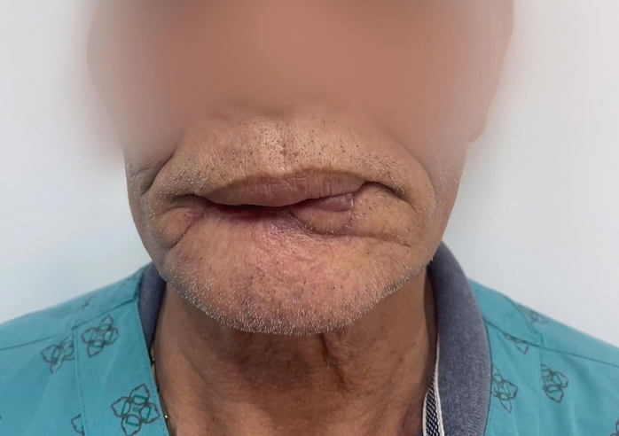 Người đàn ông bị chó cắn đứt rời môi- Ảnh 1. Người đàn ông bị chó cắn đứt rời môi- Ảnh 1.