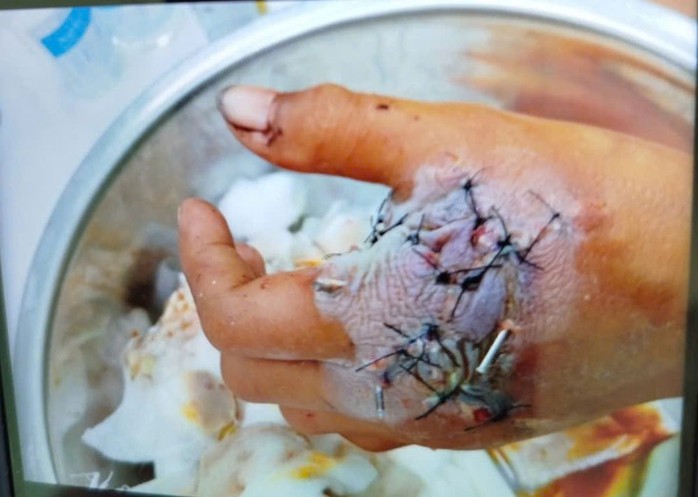 Bệnh nhi bị pháo nổ gây thương tích được cấp cứu tại Bệnh viện Nhi Đồng 2 (TP HCM). Ảnh: HẢI YẾN Bệnh nhi bị pháo nổ gây thương tích được cấp cứu tại Bệnh viện Nhi Đồng 2 (TP HCM). Ảnh: HẢI YẾN