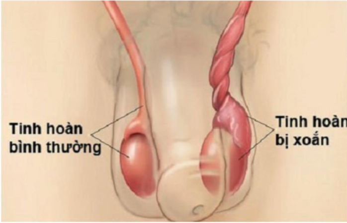 Những cơn đau “vùng kín” khiến nam giới phải cắt bỏ tinh hoàn- Ảnh 1. Những cơn đau “vùng kín” khiến nam giới phải cắt bỏ tỷ lệ kèo nhà cái 88- Ảnh 1.