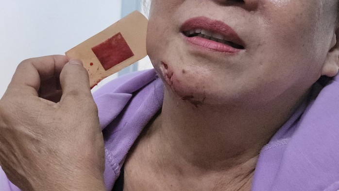 Cảnh báo bệnh dại vào mùa- Ảnh 1. Cảnh báo bệnh dại vào mùa- Ảnh 1.