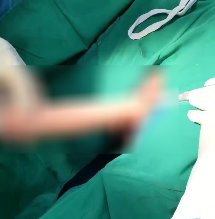 Dương vật giả mắc kẹt trong trực tràng nam thanh niên 23 tuổi- Ảnh 1. Dương vật giả mắc kẹt trong trực tràng nam thanh niên 23 tuổi- Ảnh 1.